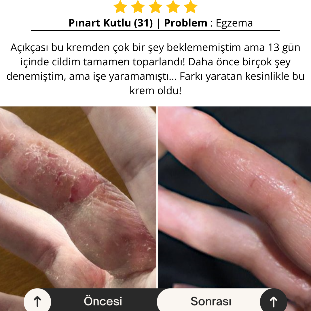 Aliyra Egzama ve Kuruluk Onarım Balmı