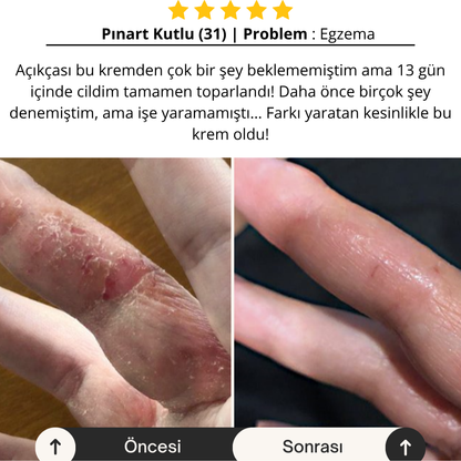 Aliyra Egzama ve Kuruluk Onarım Balmı