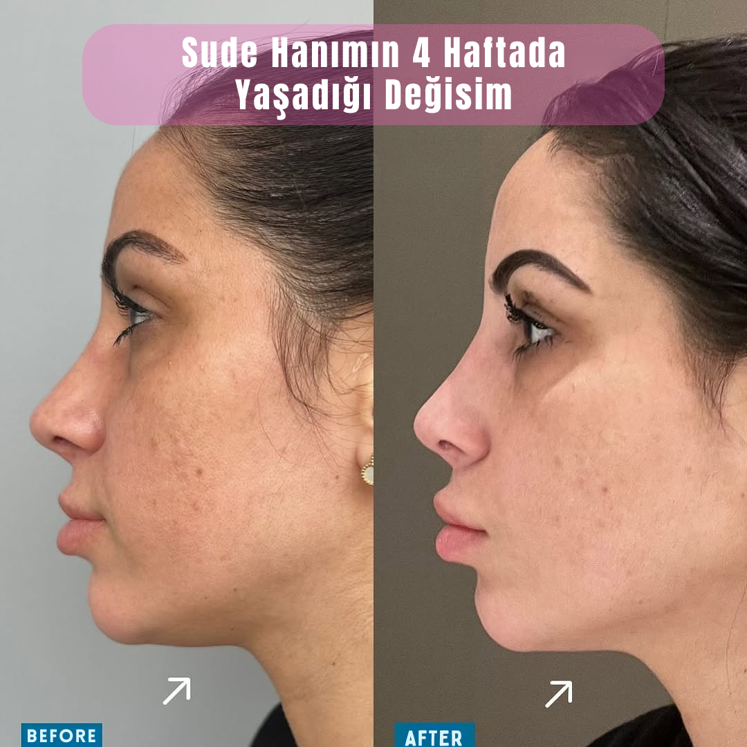 Aliyra™ Yüz Sıkılaştırma Paketi